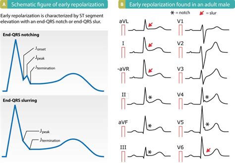 qrs widening and repolarization abnormality